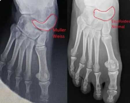 Radiografía de un pie con la Enfermedad de Müller weiss y otro con un escafoides normal