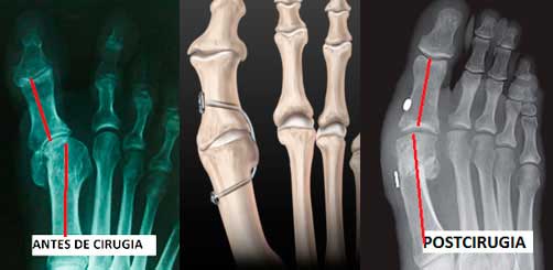 Hallux-varus-cirugía cirugía para el tratamiento del hallux varus
