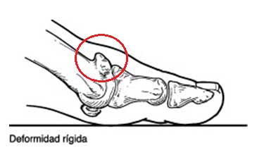biomecánica de la lesión de la artrosis metartarsofalángica del pie o hallux rigidus