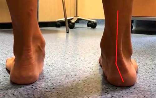 Los síntomas de presentación del pie plano del adulto flexible varían según la etapa de la enfermedad y su repercusión sobre otros tejidos.