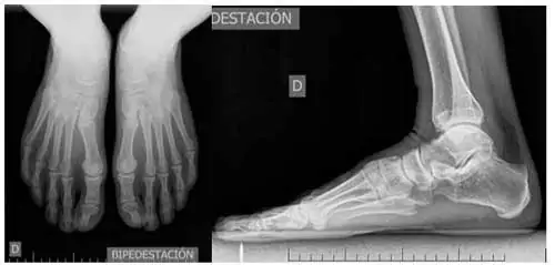 Radiografía en carga del El pie plano adquirido flexible del adulto