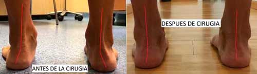 Corrección del pie plano mediante implante subtalar.