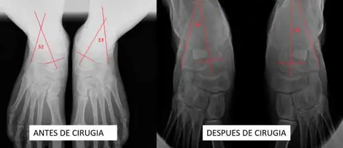 imágenes radiológicas se puede observar cómo han disminuido los grados de deformidad del pie plano adquirido del adulto flexible
