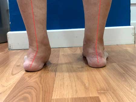síntomas del pie plano adquirido rígido del adulto