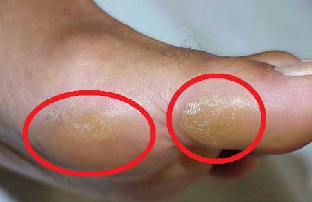 callosidades-del-pie-por-artrosis metatarsofalángica de primer dedo o Hallux rígidus