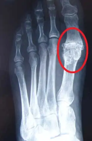 El Hallux Rigidus o artrosis metatarsofalángica es una deformidad en la articulación metatarsofalángica del primer dedo del pie