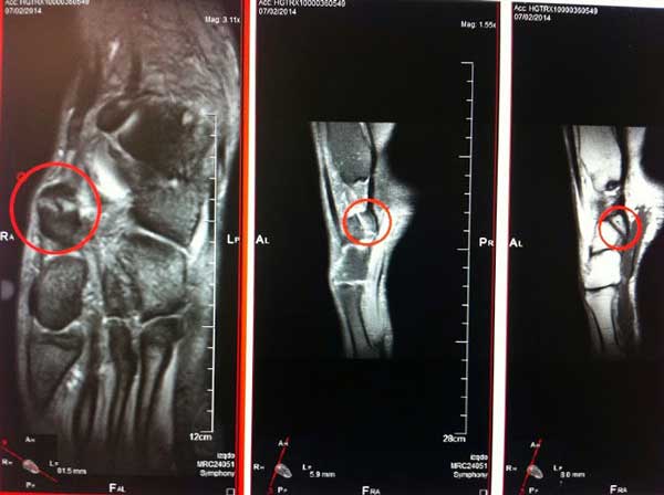 Diagnóstico del hueso tarsiano accesorio con resonancia magnéticanión fibrocartilaginosa.