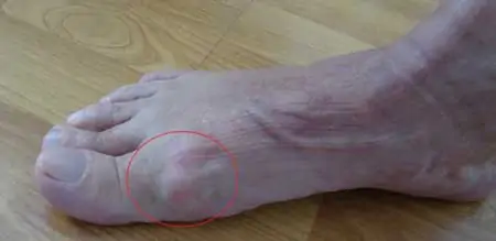 deformidad del pie producida por hallux rigidus