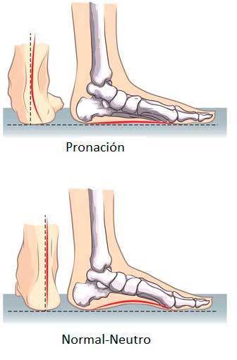 pronación del pie vs pie normal