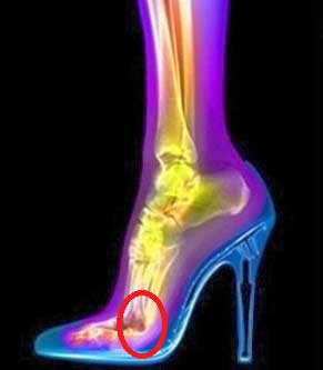 Los tacones pueden causar sesamoiditis del pie
