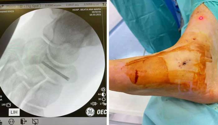 operación de una fractura del escafoides tarsiano del pie para su tratamiento
