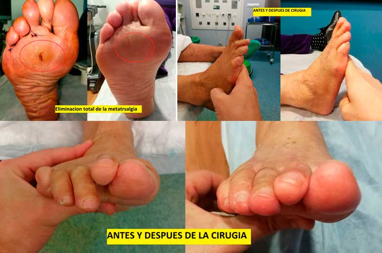 cirugía de una metatarsalgia del pie por el especialista en podología Dr. Iborra