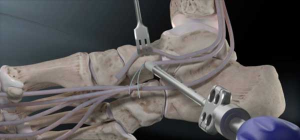 trasposición tendinosa del flexor largo de los dedos para tratar la disfunción del tendón tibial posterior del tobillo