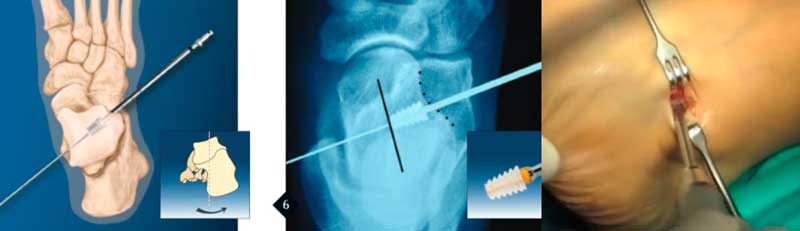 Colocación de implante en seno del tarso con incisión de 3cm en cirugía del tendón tibial posterior de tobillo