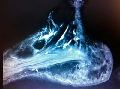 Resonancia magnética: Tenosinovitis del tendón tibial posterior.