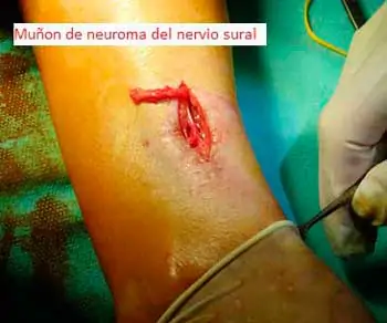 ¿Cómo se diagnostica la neuropatía del nervio sural?