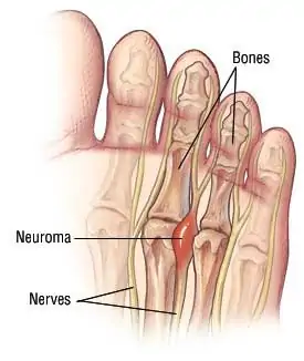 Neuroma de Morton y dolor neuropático. Localización del neuroma
