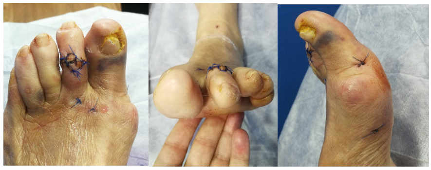 resultados de la corrección de la deformidad de los dedos en garra y juanetes