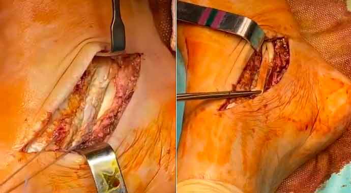 Cirugía abierta de reconstrucción tendinosa en rotura del tendón del tibial posterior asociado a transferencia tendinosa