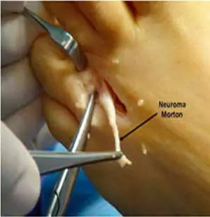 tratamiento con operación convencional del neuroma de Morton
