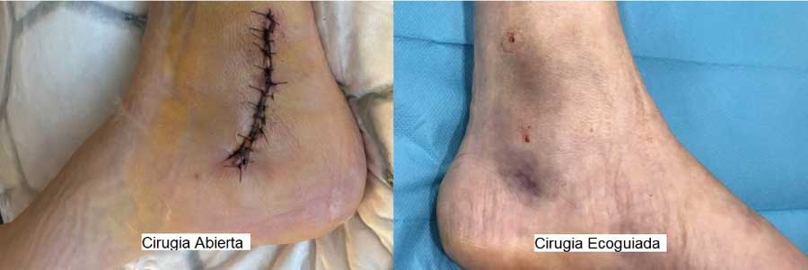 cirugía-ecoguiada-mínimamente-invasiva-de-pie-y-tobillo del síndrome del túnel tarsiano