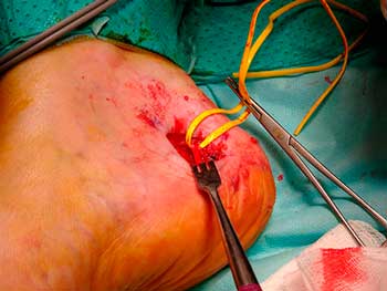 Descompresión quirúrgica del nervio rama calcánea medial