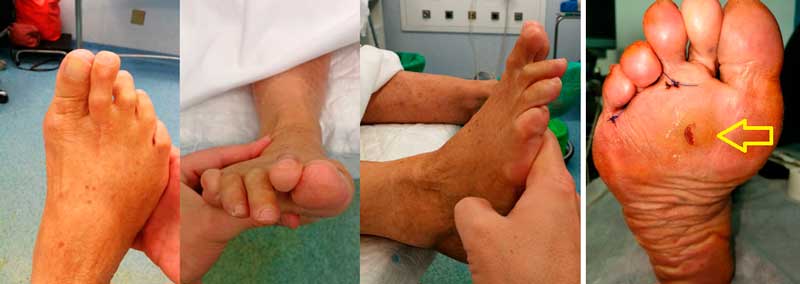 cirugía de una metatarsalgia del pie