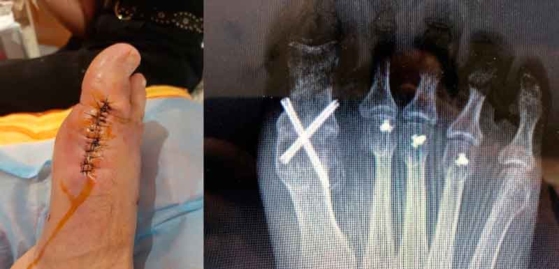 cirugía abierta para reconstrucción de antepié asociado a artrodesis del dedo gordo por artrosis severa