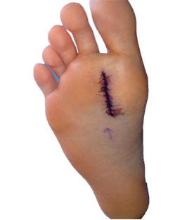 Neuroma-de-Hueter o Neuritis. Lesiones del nervio periférico del pie