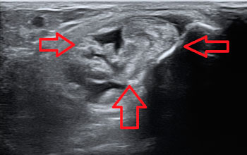 diagnóstico de la rotura de los tendones peroneos con ecografía