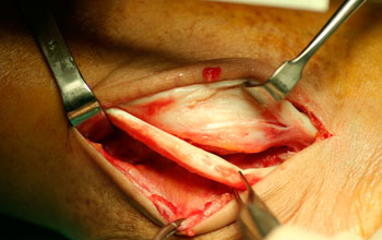 tratamiento quirúrgico de la rotura de los tendones peroneos