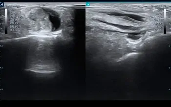 Tendinitis-de-los-peroneos-IV Ecografía: Tenosinovitis peroneos