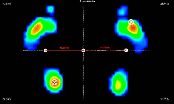 Tendinitis-de-los-peroneos-VI Estudio biomecánico de la pisada