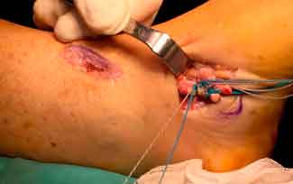 operación abierta de un paciente con rotura completa del tendón tibial anterior