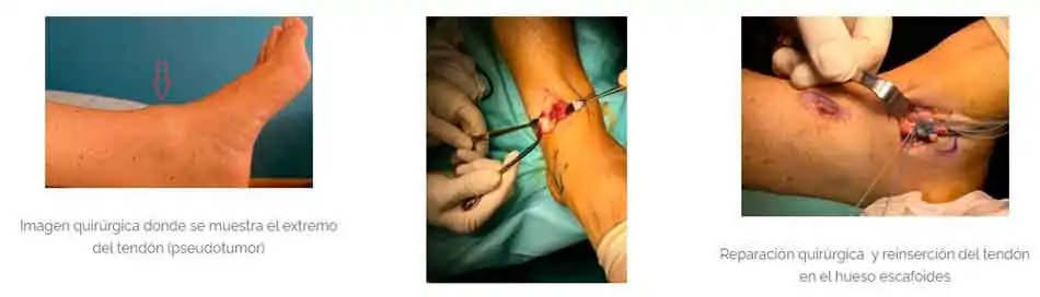 tratamiento quirúrgico de la rotura completa del tendón tibial anterior