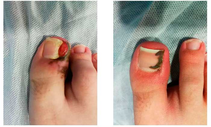 testimonio de infección por uña clavada u onicocriptosis en el pie