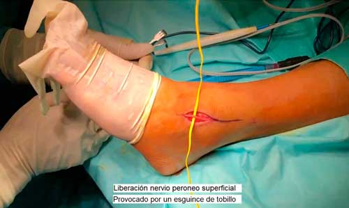 cirugía de liberación-del-nervio-peroneo-superficial
