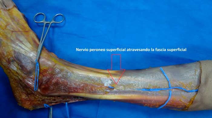 disección anatómica del nervio peroneo superficial
