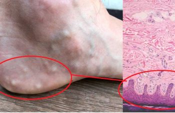 Qué son y cómo se tratan las pápulas o bultos de grasa dolorosos en los pies