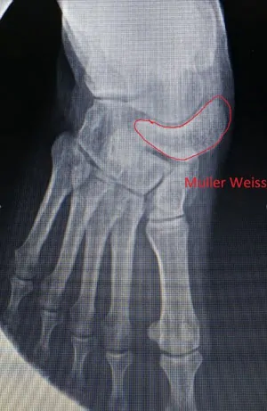 radiografía de paciente con la deformidad de Müller Weiss