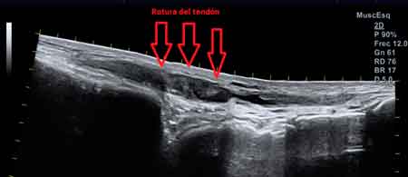 diagnóstico de una rotura del tendón tibial anterior