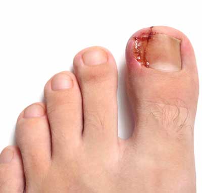 onicocriptosis o uñas encarnadas de los pies