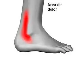 Dónde-duelen-los-tendones-peroneos Síntomas de la tendinitis de los peroneos