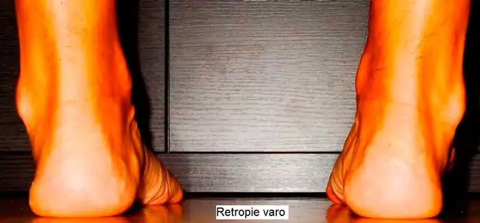 tendinitis-de-los-tendones-peroneos-y-pie-retrovaro ¿Qué causa de la tendinitis de los peroneos?