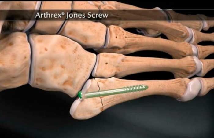 Fractura de Jones en el pie tratamiento