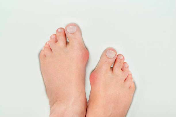 Hallux Valgus O Juanetes ¿qué Es Causas Y Síntomas Doctor Iborra 8546