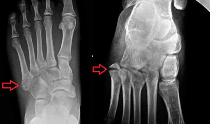 Radiografía de paciente con una fractura de Jones en el pie