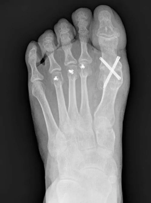 Cirugía para artrosis del dedo gordo Hallux rígidux, metatarsalgia y neuroma de Morton
