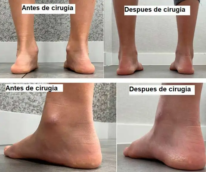 Beneficios de la cirugía del pie plano en niños