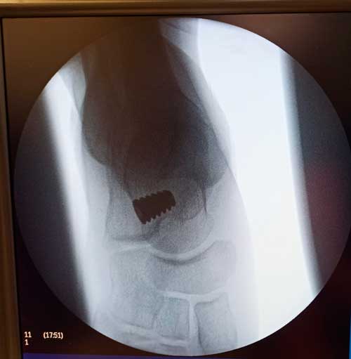 Radiografía del Implante utilizado en la cirugía de un pie plano en niño